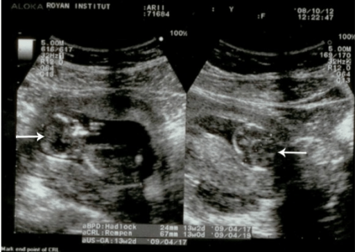 Pregnancy: The Impact of Maternal Nutrition on Intrauterine Fetal ...