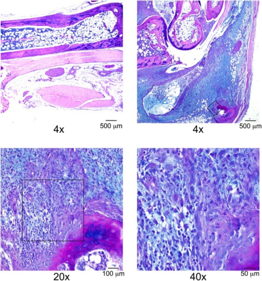 What is Lyme Arthritis? Pathosomes