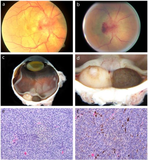 What are Uveal Melanomas? Pathosomes