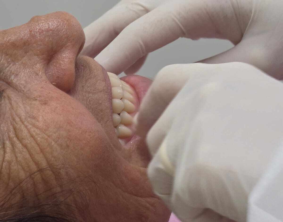 Nova Venécia entrega mais 60 próteses dentárias e avança para zerar fila de espera