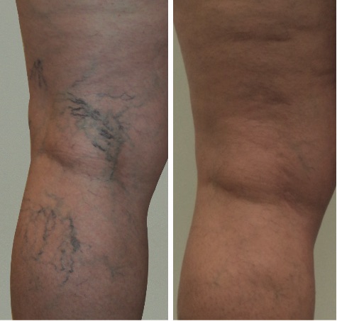 Think your legs look better covered up these days? Varicose and Spider Vein Removal in Crest Hill & Naperville | Premier Dermatology
