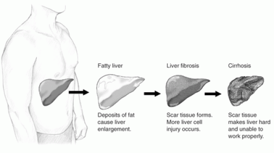 Difference Between Jaundice and Hepatitis