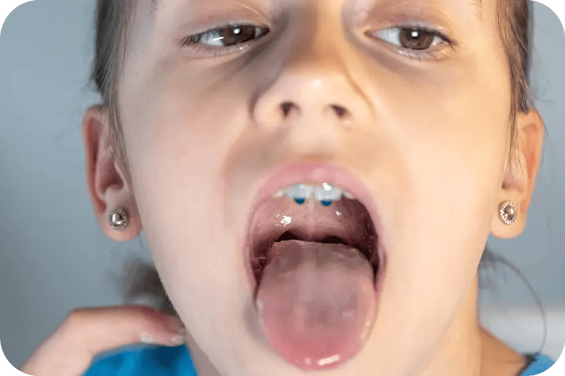 Laryngomalacia Treatment Dubai