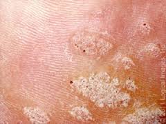 Verrues en mosaïque