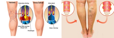 Apakah Itu Varises??? - Pelita Biomedical (PBM)