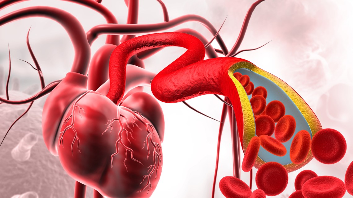 Cholesterol,In,Human,Heart,,Clogged,Blood,Vessels,3d,Illustration.