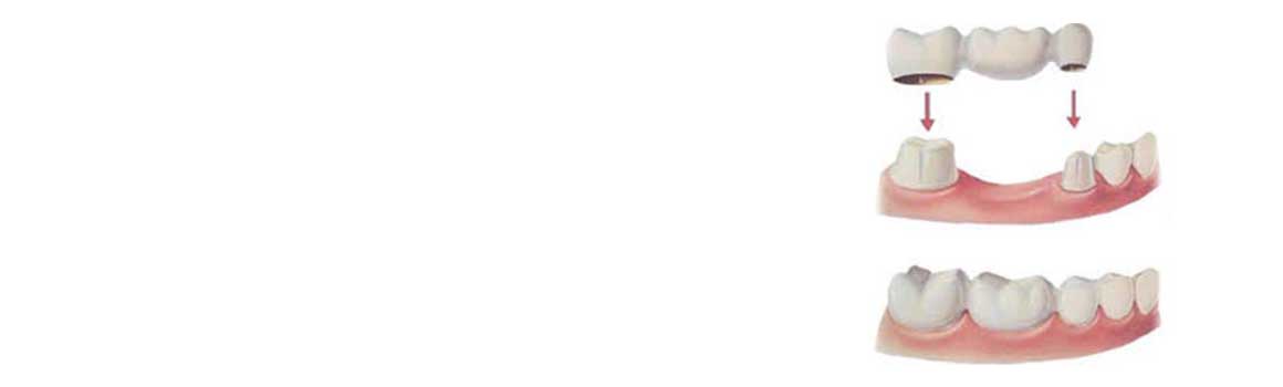 Biaya pembersihan karang gigi memang cukup bervariasi apalagi anda ingin melakukan pembersihan karang gigi di klinik prbadi atau rumah sakit. ahli sambung gigi permanen denpasar bali | Mau Pasang Gigi