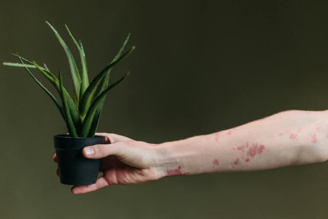A close-up of a hand with a skin condition holding a potted aloe vera plant against a green background.