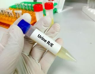 Urine, R_E (Routine Examination)