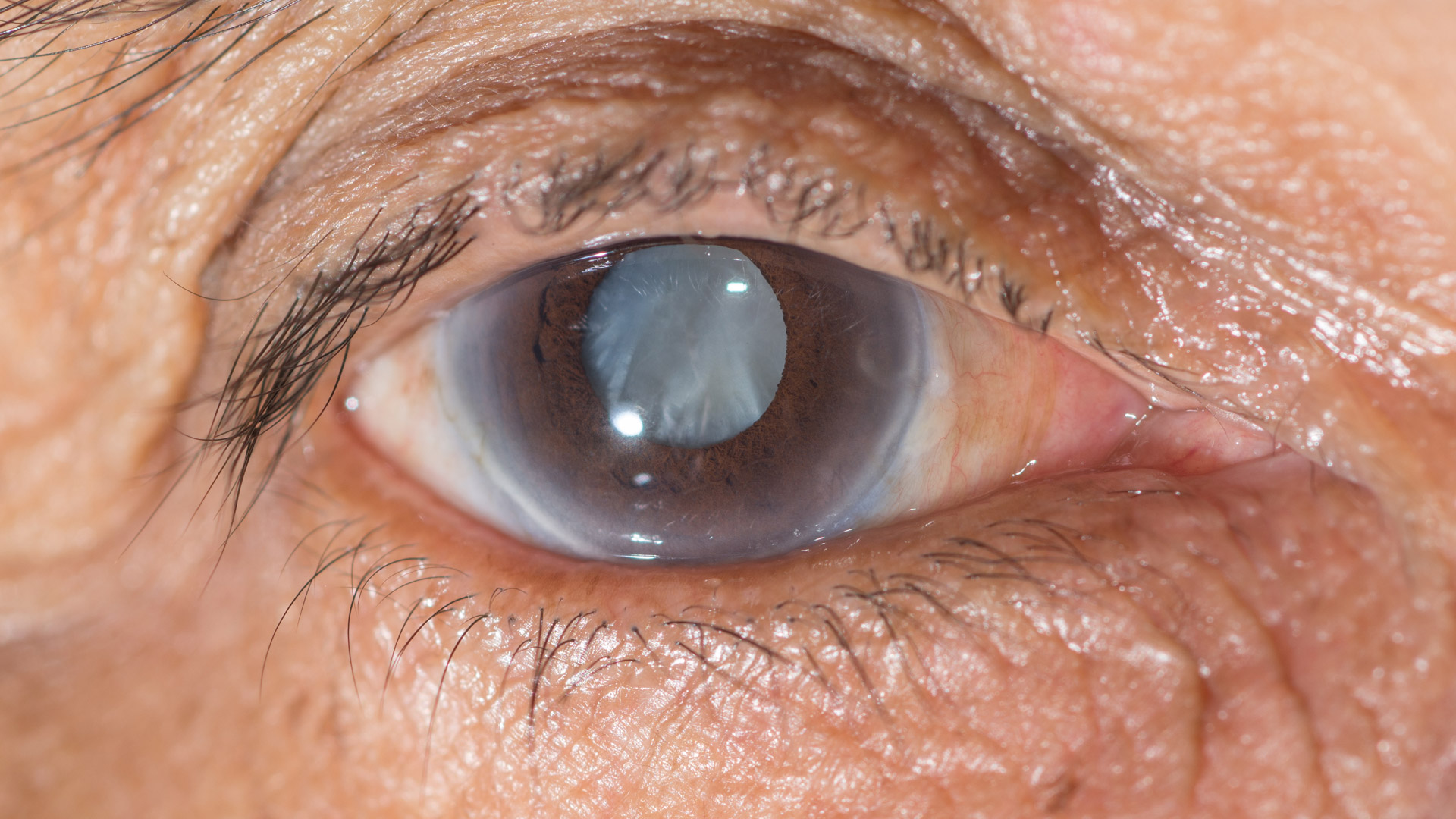 Cataract evaluation and surgery