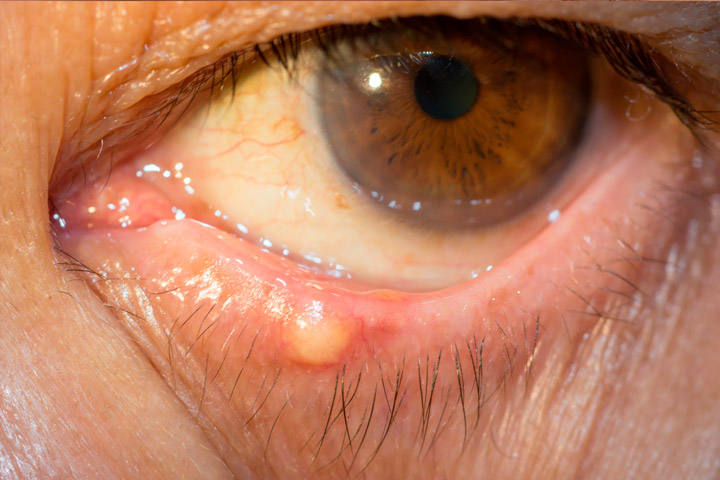 Styes and chalazions