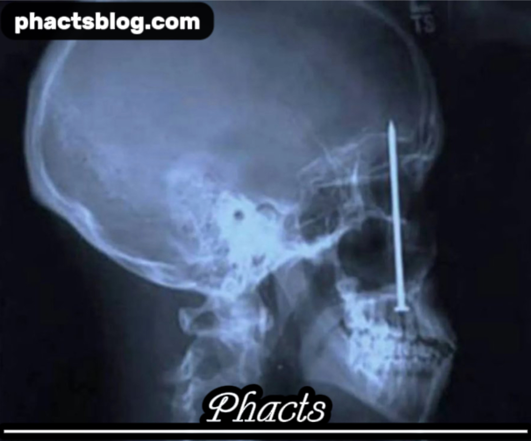 Patrick Lawler’s Toothache: The Shocking Nail Gun Accident