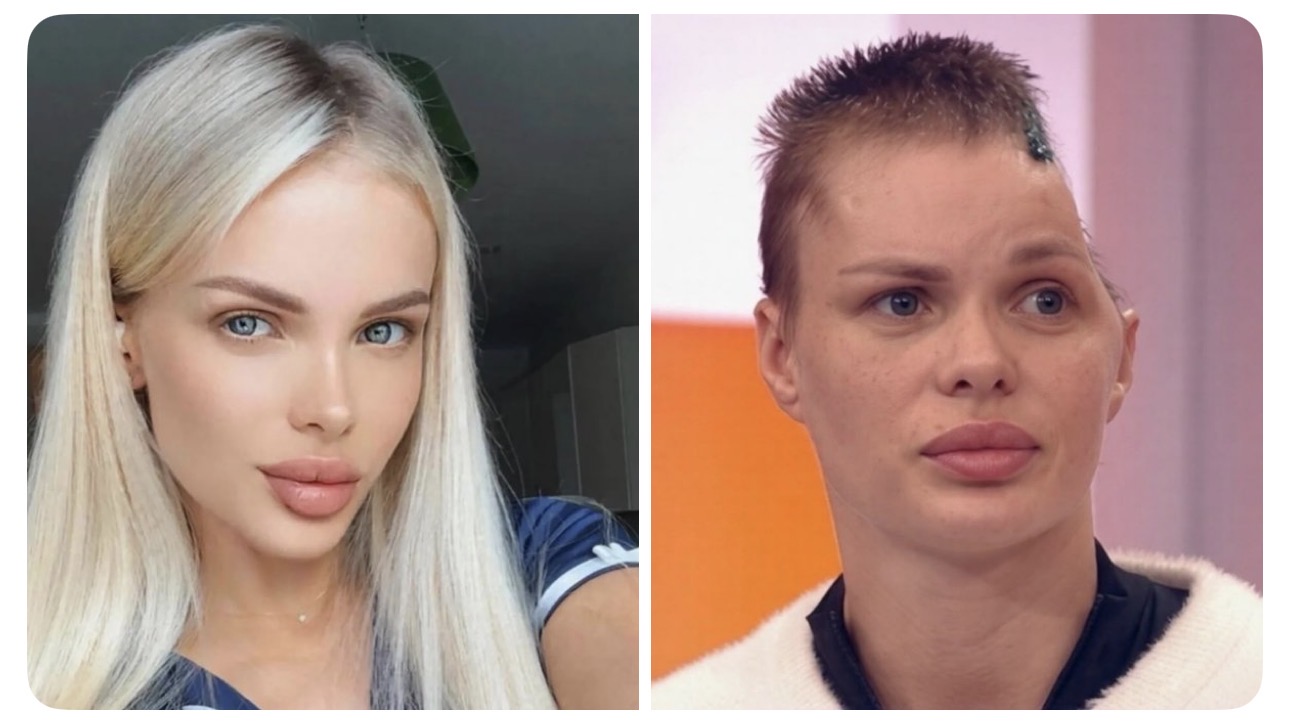 Angelika Tartanova Lost Part of Her Skull After Brutal Beating by Boyfriend