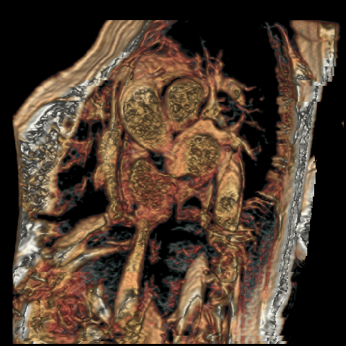 4D MRI of atrial septal aneurysm acquired and processed by JDPearlman