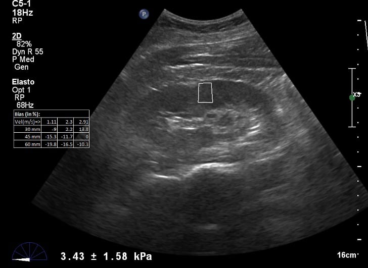 The most common and aggressive type of renal cell carcinoma is the clear cell type. Ultrasound Elastography Is A Quick And Non Invasive Way To Spot Kidney Failure Physics World