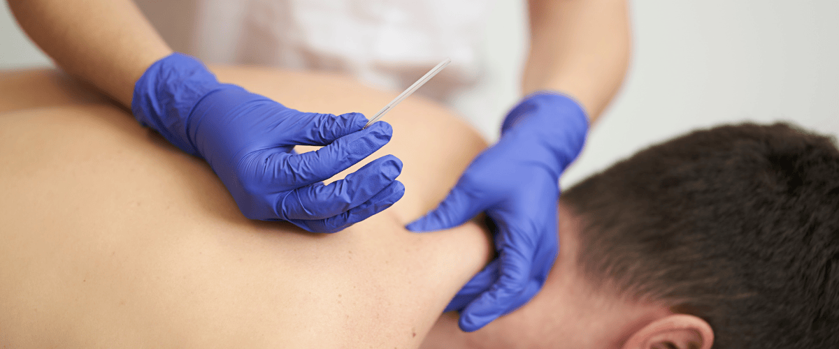 dry needling