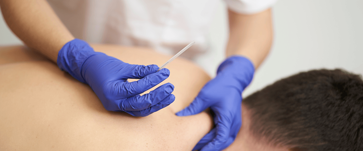 dry needling