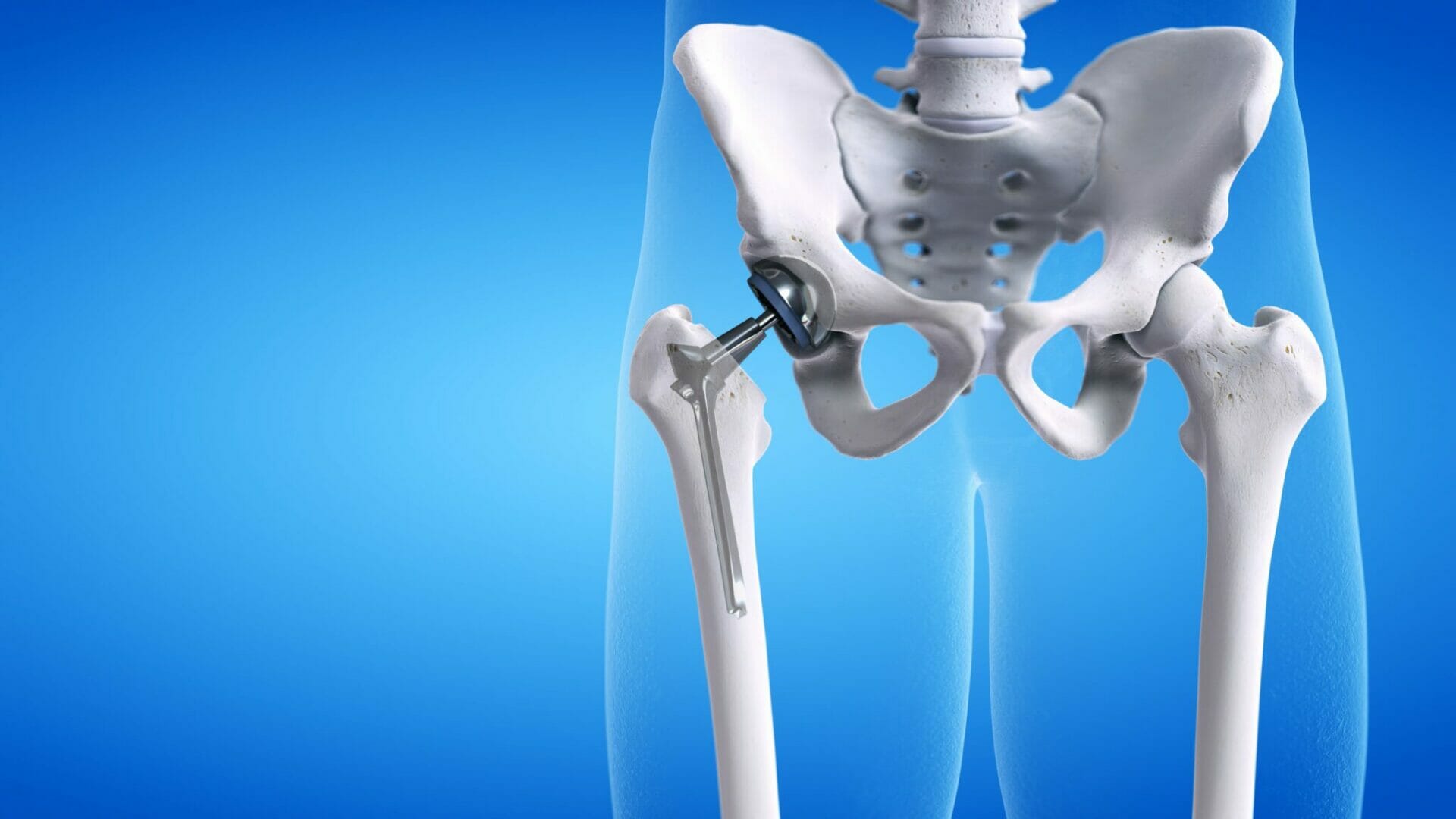 6 weeks after a total hip replacement