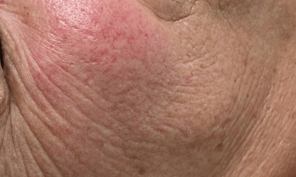 skin1