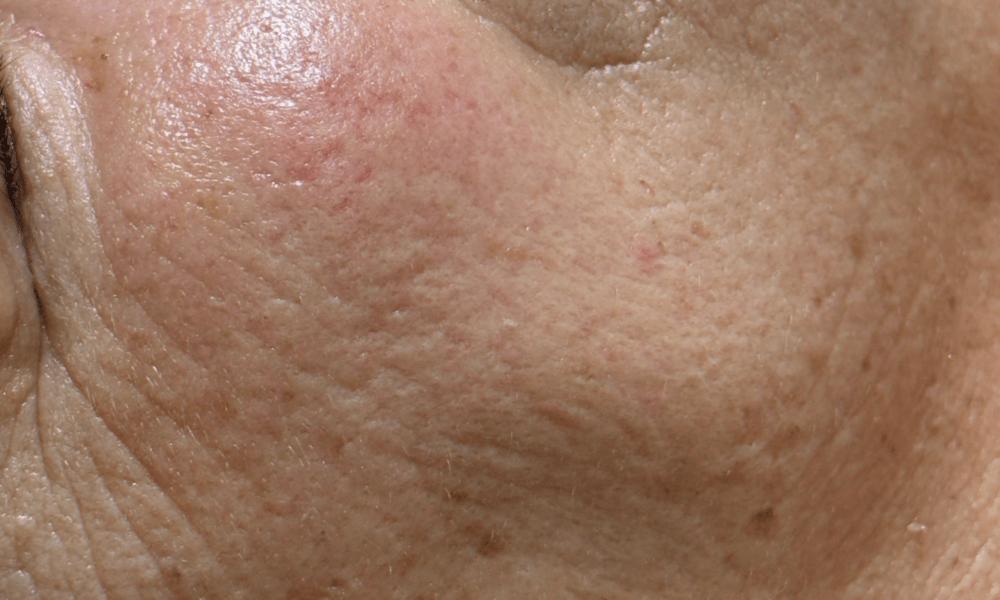 skin2