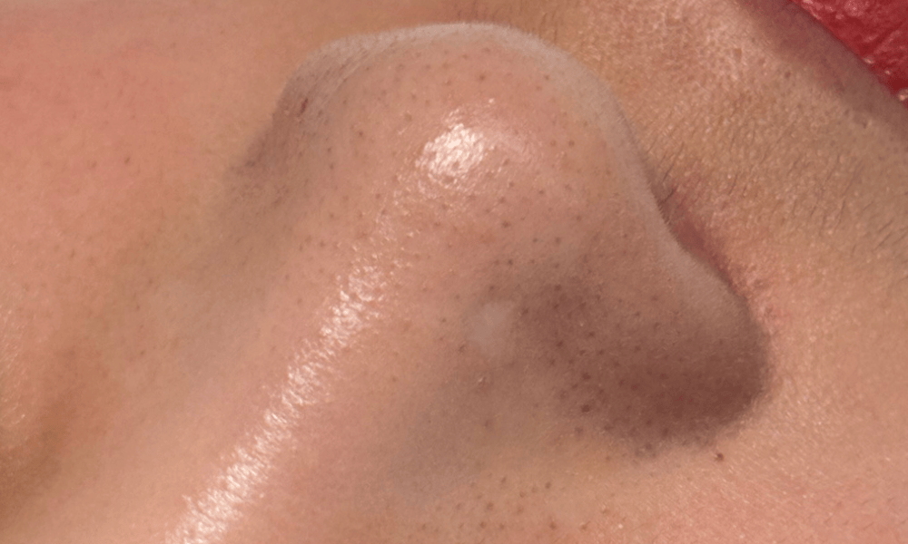 skin3