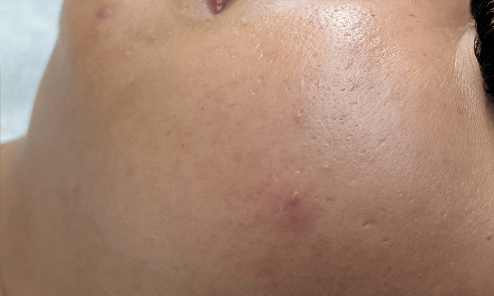 skin6