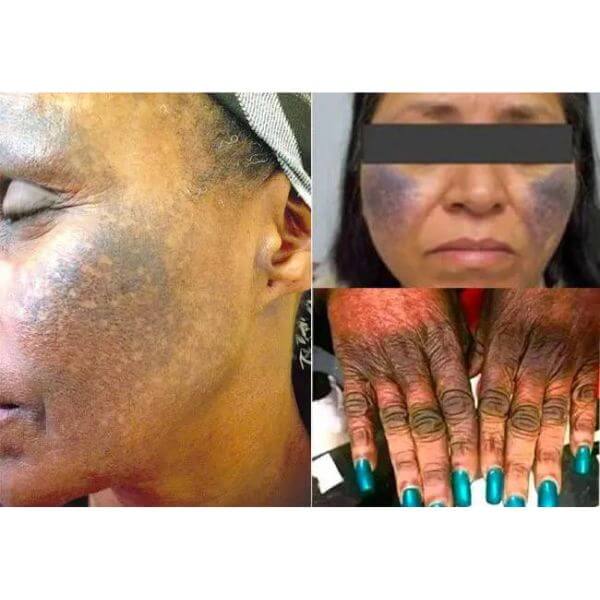 Skin Bleaching Gone Wrong. What You Should Know