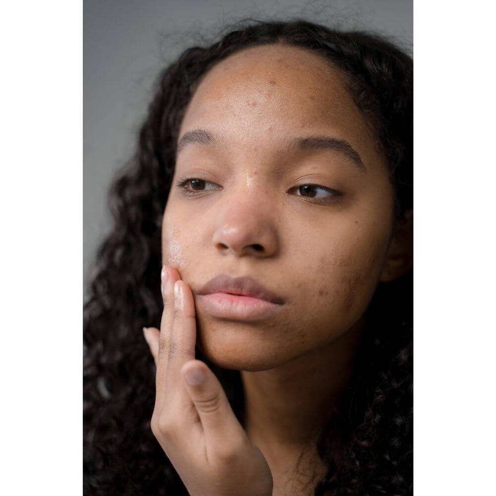 How To Get Rid Of Pimple On The Forehead