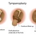 How Otolaryngologists Help In Managing Ear Drum Ruptures