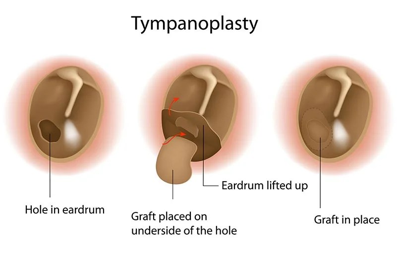 How Otolaryngologists Help In Managing Ear Drum Ruptures