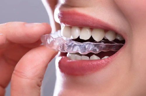 Can sleep apnea be treated with Invisalign?