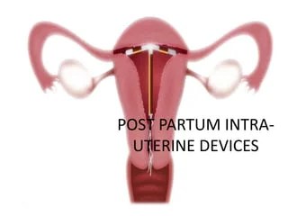 Post-partum-iud-insertion-2-320