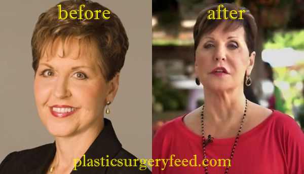 Joyce Meyer Lip Injections _ Joyce Meyer Plastic Surgery Journey Before ...