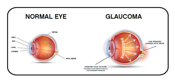 Glaucoma