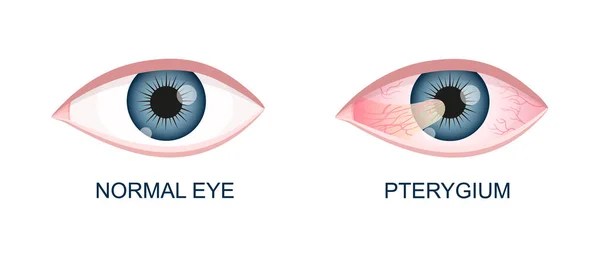 Pterygium