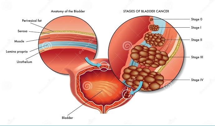 Bladder Cancer