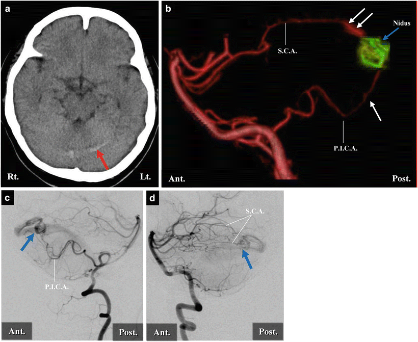 Three Cerebellar Arteries: Superior Cerebellar Artery, Anterior