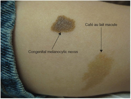 She was the girls' doubles silver medalists at . Pigmented Lesions and Melanoma | Plastic Surgery Key