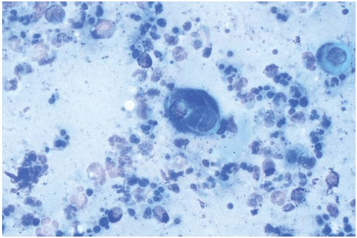 Herpes Simplex | Plastic Surgery Key