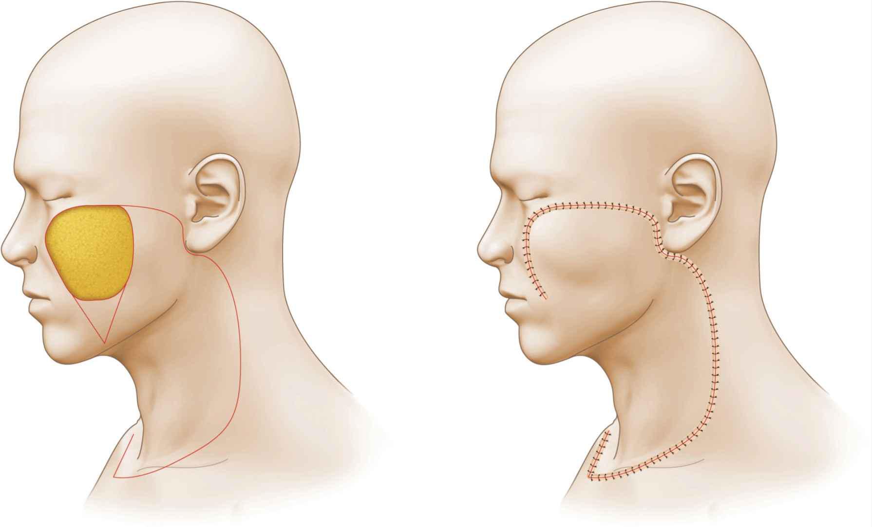 Cheek | Plastic Surgery Key