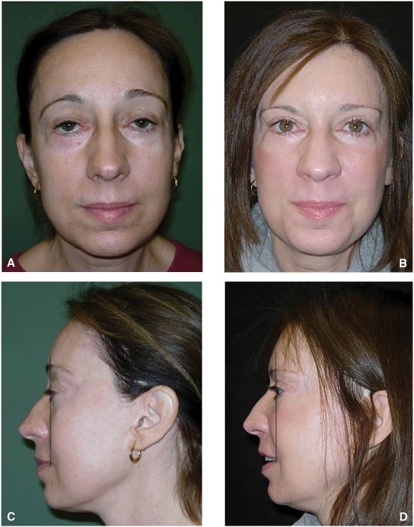 Midface Rejuvenation Plastic Surgery Key