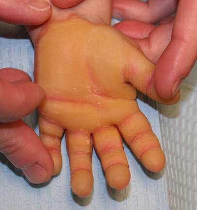 Hereditary Disorders of Cornification | Plastic Surgery Key