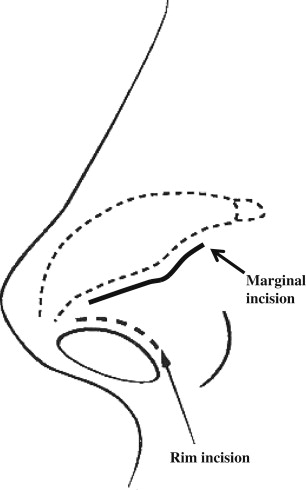 Revision Rhinoplasty | Plastic Surgery Key