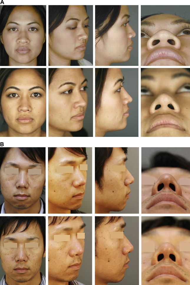 健康・医学 atlas of asian rhinoplasty Atlas of Asian Rhinoplasty Full Text | PDF | Human Nose