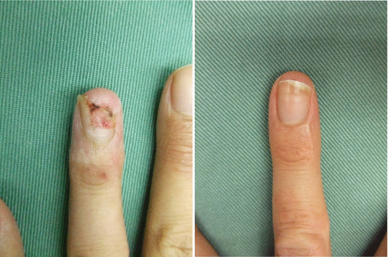 Nail Reconstruction Plastic Surgery Key