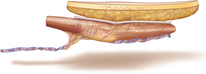 Rectus Abdominis Flap | Plastic Surgery Key