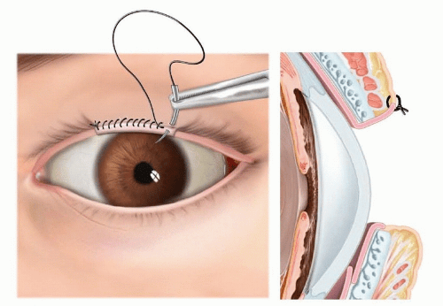 Eyelid Coloboma | Plastic Surgery Key