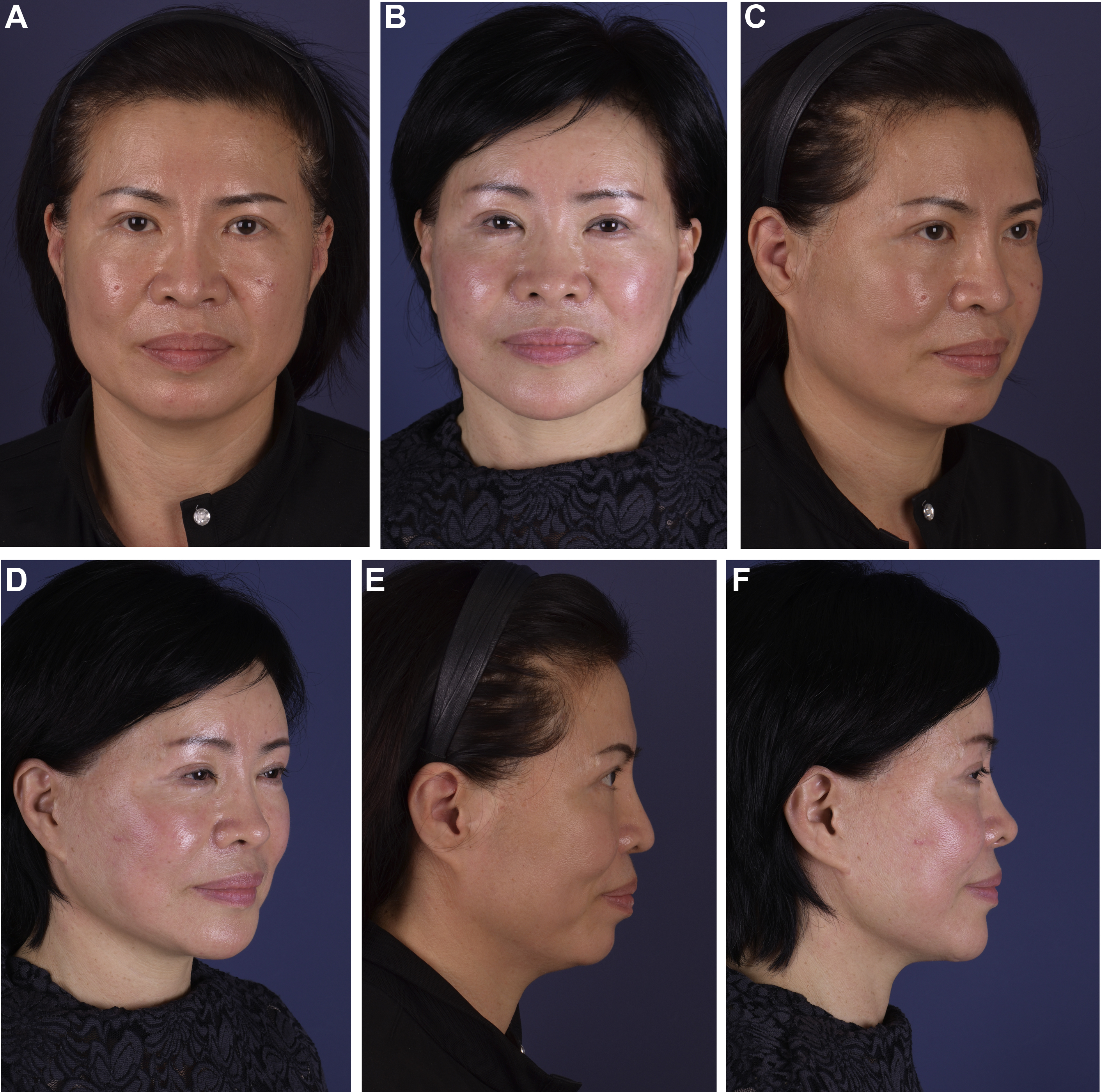 Asian Facelift | Plastic Surgery Key
