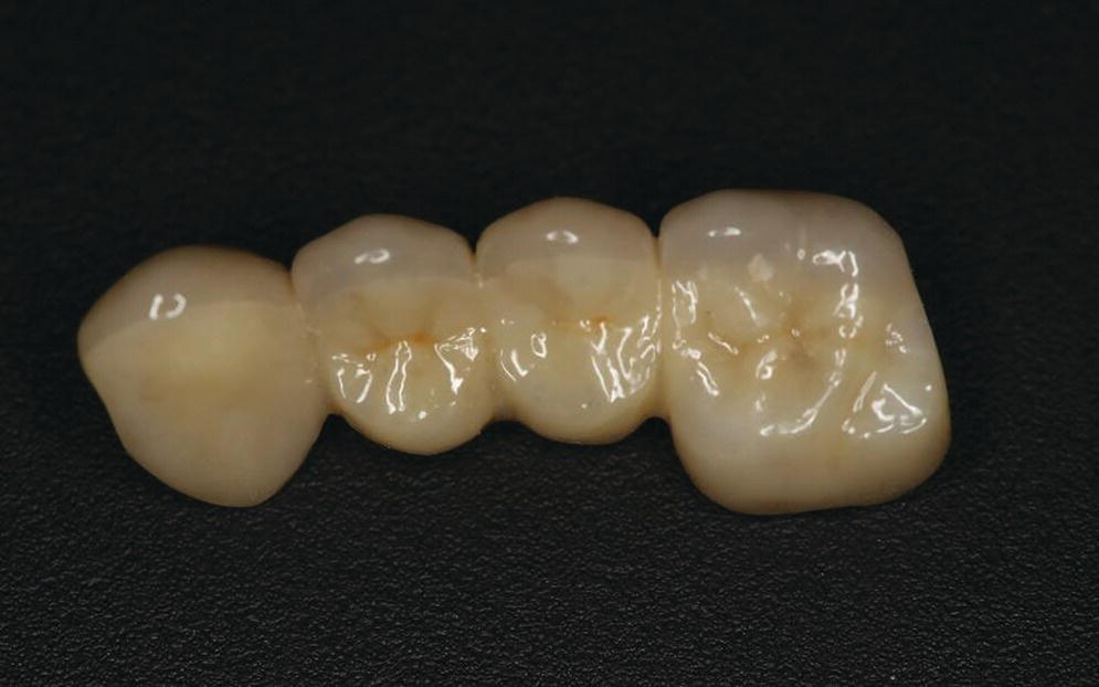 11 Ceramic Materials in Implant Dentistry Pocket Dentistry