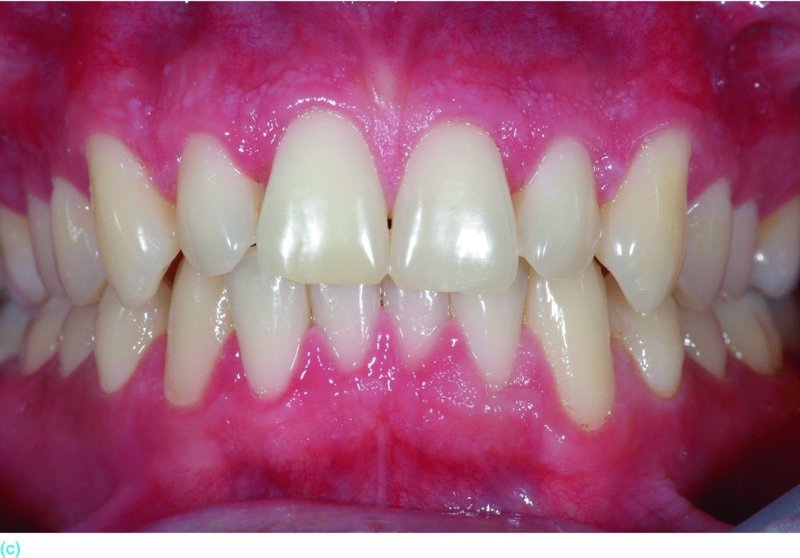 Nonvital Bleaching Pocket Dentistry